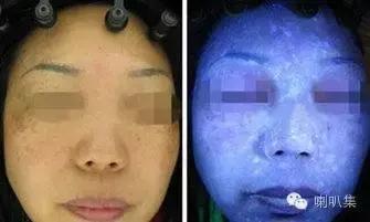 喇叭集闻问：两周让皮肤上瘾，谨防朋友圈的“面膜*片鸦**”