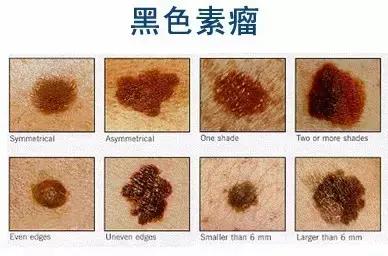 身上有没有痣是什么决定的,身上的痣很少说明什么