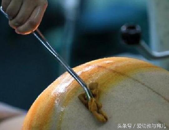 单亲孕妈流产,35宝妈四次剖腹产的经历