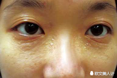 脂肪粒会不会变成汗管瘤,你以为的脂肪粒可能是汗管瘤