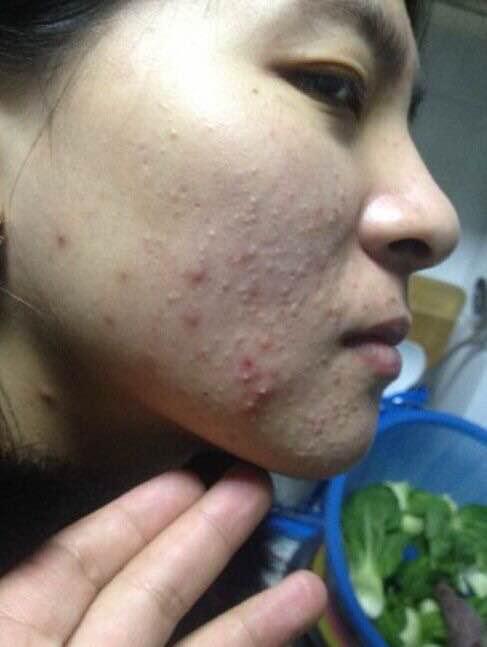 不同类型的痘痘怎么解决,痘痘不同阶段