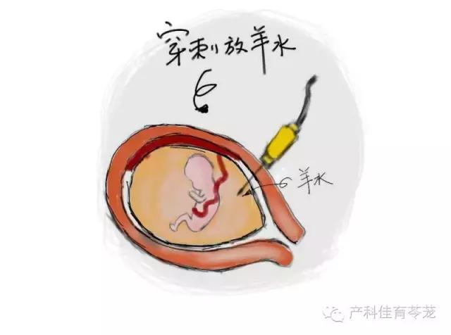 羊水过多和过少的原因,怎么预防羊水过多或过少