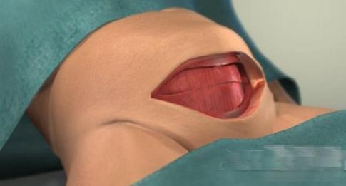 剖腹产的女人请好好珍惜,剖腹产女人要受多少罪