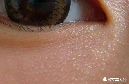 脂肪粒会不会变成汗管瘤,你以为的脂肪粒可能是汗管瘤