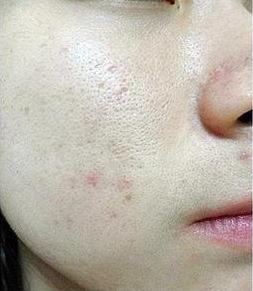 为什么皮肤毛孔粗大,毛孔粗大的真正原因到底是什么