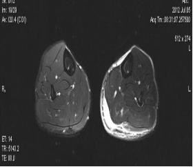 肩周炎中频电疗处方,颈椎病理疗中频电疗