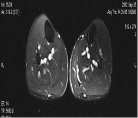肩周炎中频电疗处方,颈椎病理疗中频电疗