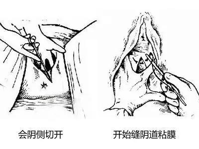 准妈妈对于侧切你了解多少,侧切的宝妈