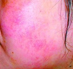 皮肤呈现红血丝怎么回事,皮肤红血丝是怎么引起的