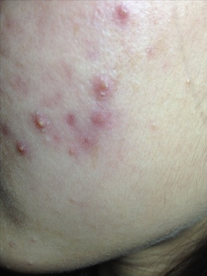 皮肤呈现红血丝怎么回事,皮肤红血丝是怎么引起的