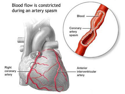 心脏支架手术和搭桥哪个风险大,心脏支架可能的风险