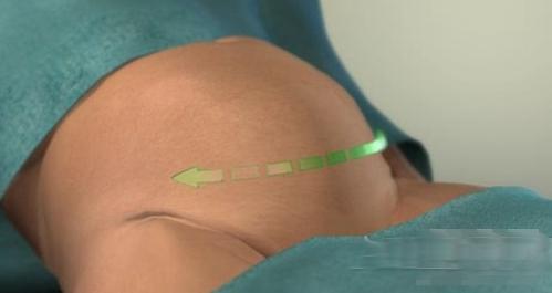 剖腹产的女人请好好珍惜,剖腹产女人要受多少罪