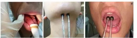 周惠嫦主任:鼻咽癌放疗后吞咽康复治疗的方法