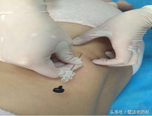 穴位埋线疗法,埋线治什么病