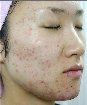 痘印怎么快速消除,痘痘怎么快速消除不留痘坑