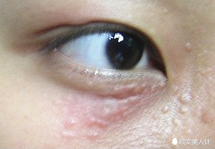 脂肪粒会不会变成汗管瘤,你以为的脂肪粒可能是汗管瘤