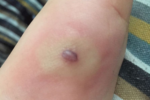 宝宝手臂红肿化脓,小孩手指有脓肿是什么病