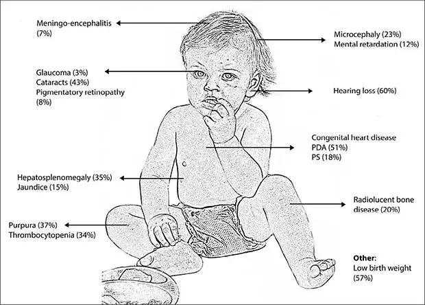 当“风疹”遇见“怀孕”，一场本可以避免的灾难事件