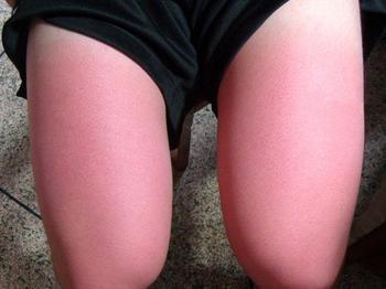 如何拯救晒伤的肌肤,我该如何拯救你