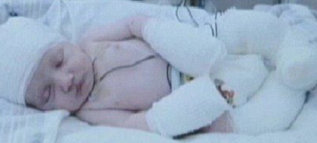 胎儿颈部无包块皮肤水肿什么意思,三个月胎儿全身皮肤水肿的原因