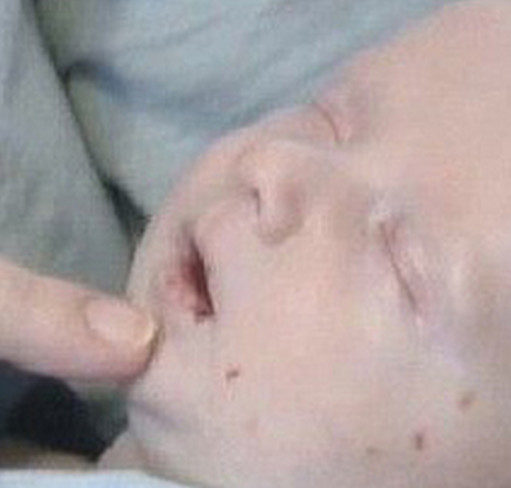 胎儿颈部无包块皮肤水肿什么意思,三个月胎儿全身皮肤水肿的原因