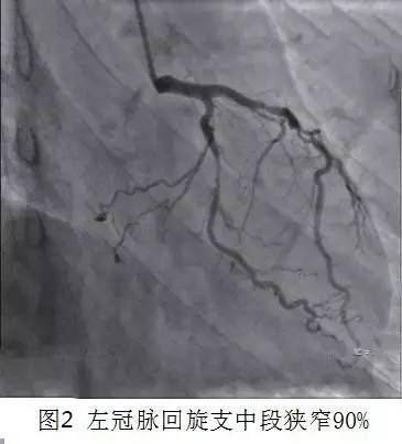 冠心病会长黄色瘤不,年轻人高发冠心病