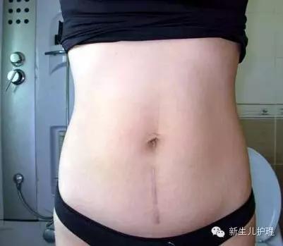 难看的剖腹产疤痕怎么去除,剖腹产刀疤太丑了怎么办