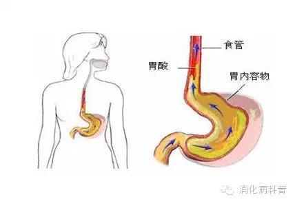 胃胀反酸烧心吃什么药,反酸烧心是怎么一回事如何治疗