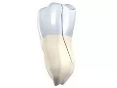 牙隐裂有多少人,牙隐裂算几级伤