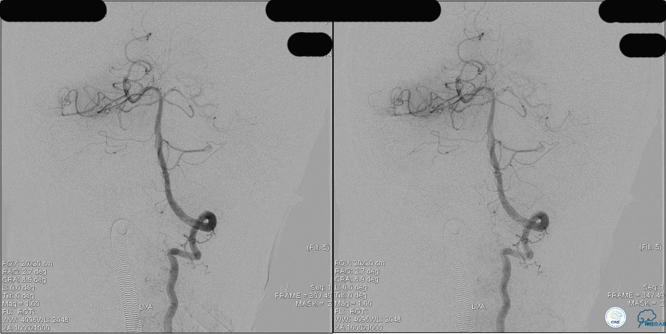 冠状动脉慢性闭塞的介入治疗,颅外段锥动脉狭窄的介入治疗