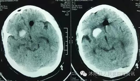 沭阳人民医院神经内科,神经外科烟雾病手术