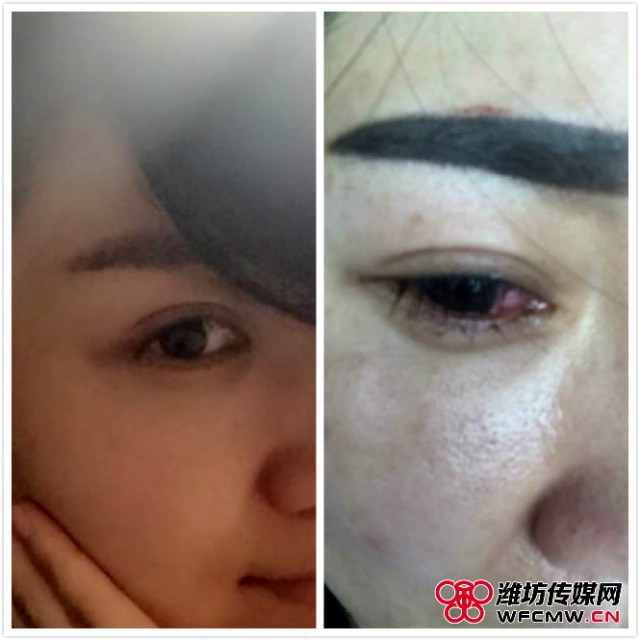 纹美瞳线后眼睛瞎了,纹了美瞳线眼睛模糊