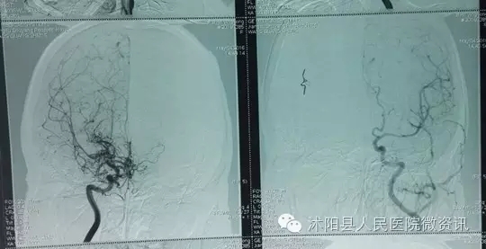 沭阳人民医院神经内科,神经外科烟雾病手术