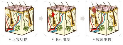 小时候长疮疤痕怎么消除,痘疮怎么治疗好得快