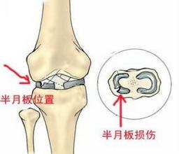 膝关节疼痛未必是半月板损伤,怎么鉴定半月板损伤是外伤造成的