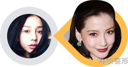 玻尿酸丰脸颊亲身经历,玻尿酸丰太阳穴脸变大了