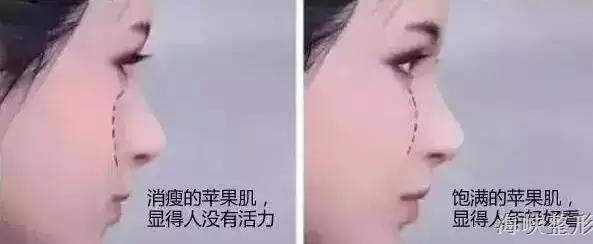 玻尿酸丰脸颊亲身经历,玻尿酸丰太阳穴脸变大了