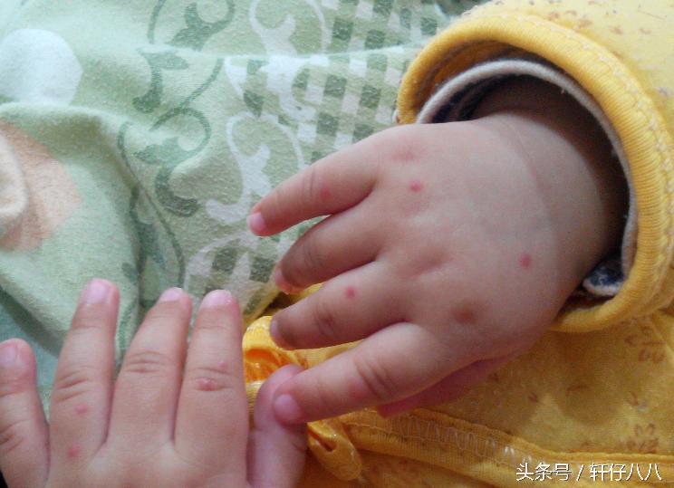 表妹家5个月宝宝患手足口险丧命，预防手足口病的食疗偏方