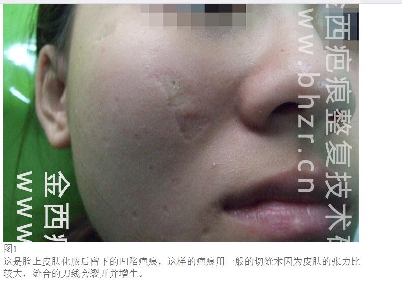 脸上点痣留下的疤痕该怎么办,怎么去除脸上的疤痕