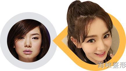 玻尿酸丰脸颊亲身经历,玻尿酸丰太阳穴脸变大了