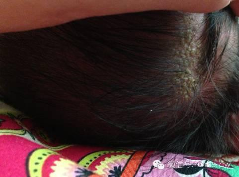 6岁男童头皮屑特别多是怎么回事,小男孩有很多头屑