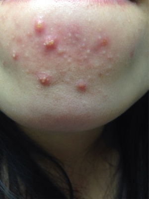 下巴长痘痘的图片和分析,下巴长痘老中医推荐