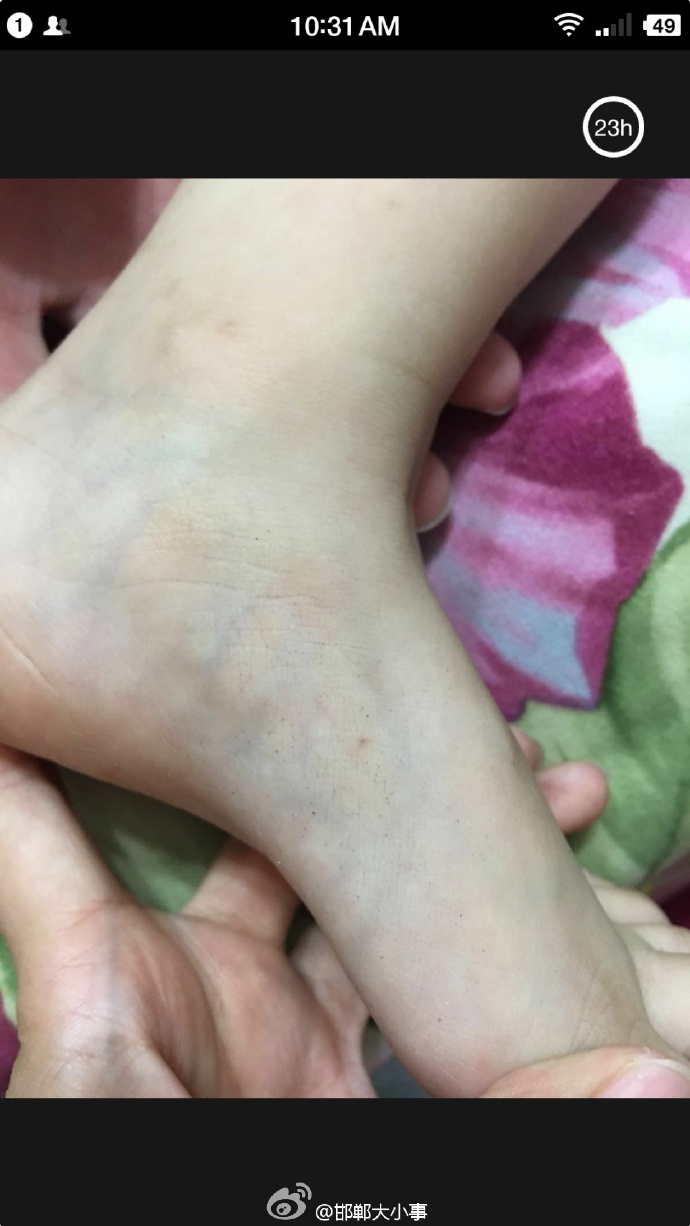 河南一幼儿园针扎小朋友事件,朔州幼儿园针扎幼儿事件