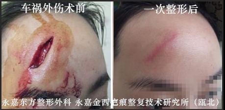 脸上点痣留下的疤痕该怎么办,怎么去除脸上的疤痕