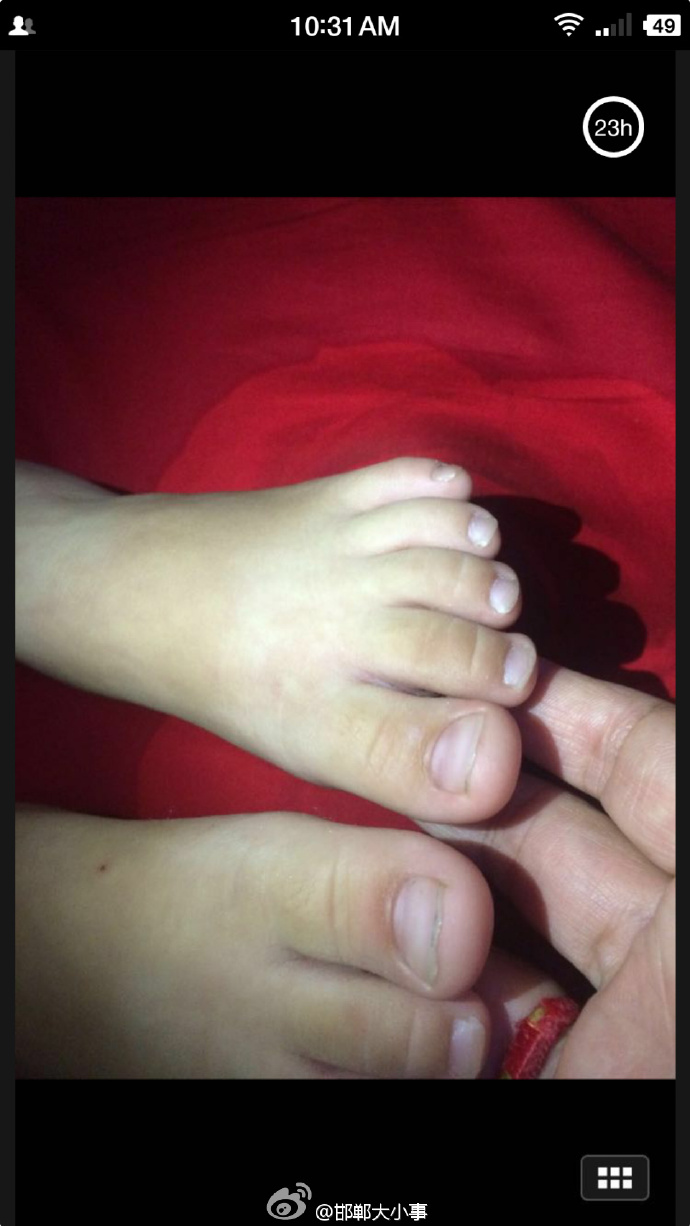 河南一幼儿园针扎小朋友事件,朔州幼儿园针扎幼儿事件