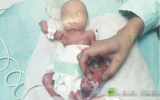 妊娠高血压出生的孩子成长案例,39岁高龄产妇生二胎凶险异常