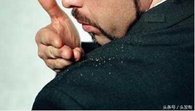 脱发掉头发用什么类型洗发水,总用一款洗发水会有头皮屑吗