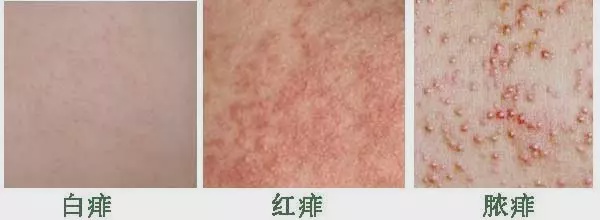 出痱子怎么办成人,痱子的原因及相对应的护理方法