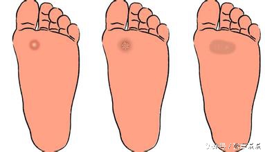 脚上长鸡眼中医偏方,脚上长鸡眼的中医治疗