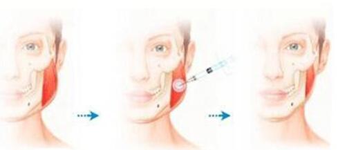 青霉素过敏可以注射胸腺肽吗,青霉素过敏可以注射肉毒素吗